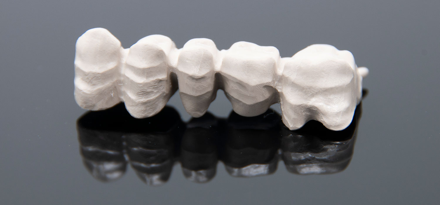 Peek dental prostheses