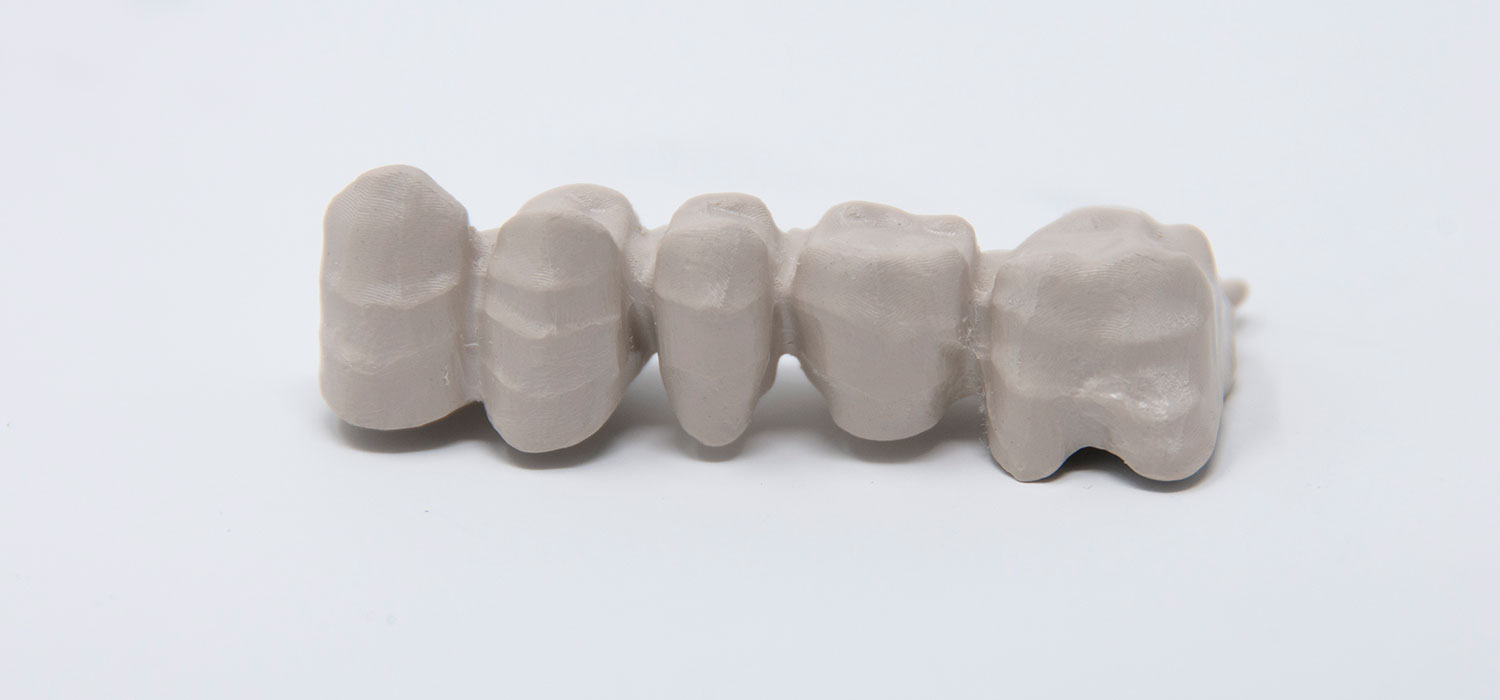 Peek dental prostheses